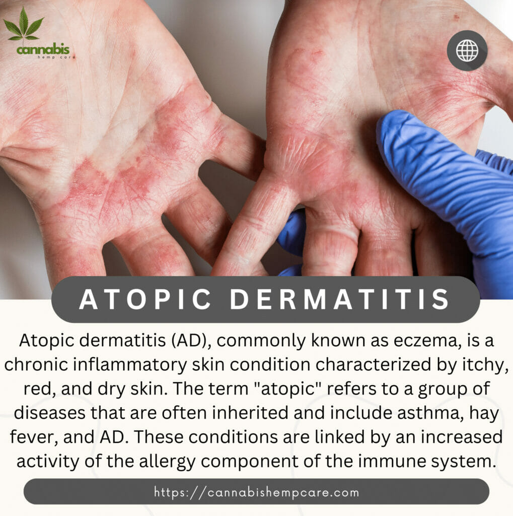 Atopic dermatitis