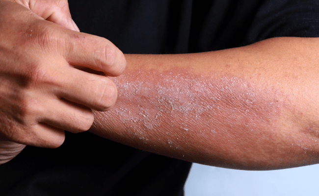 Eczema allergy skin, dermatologic diseases.