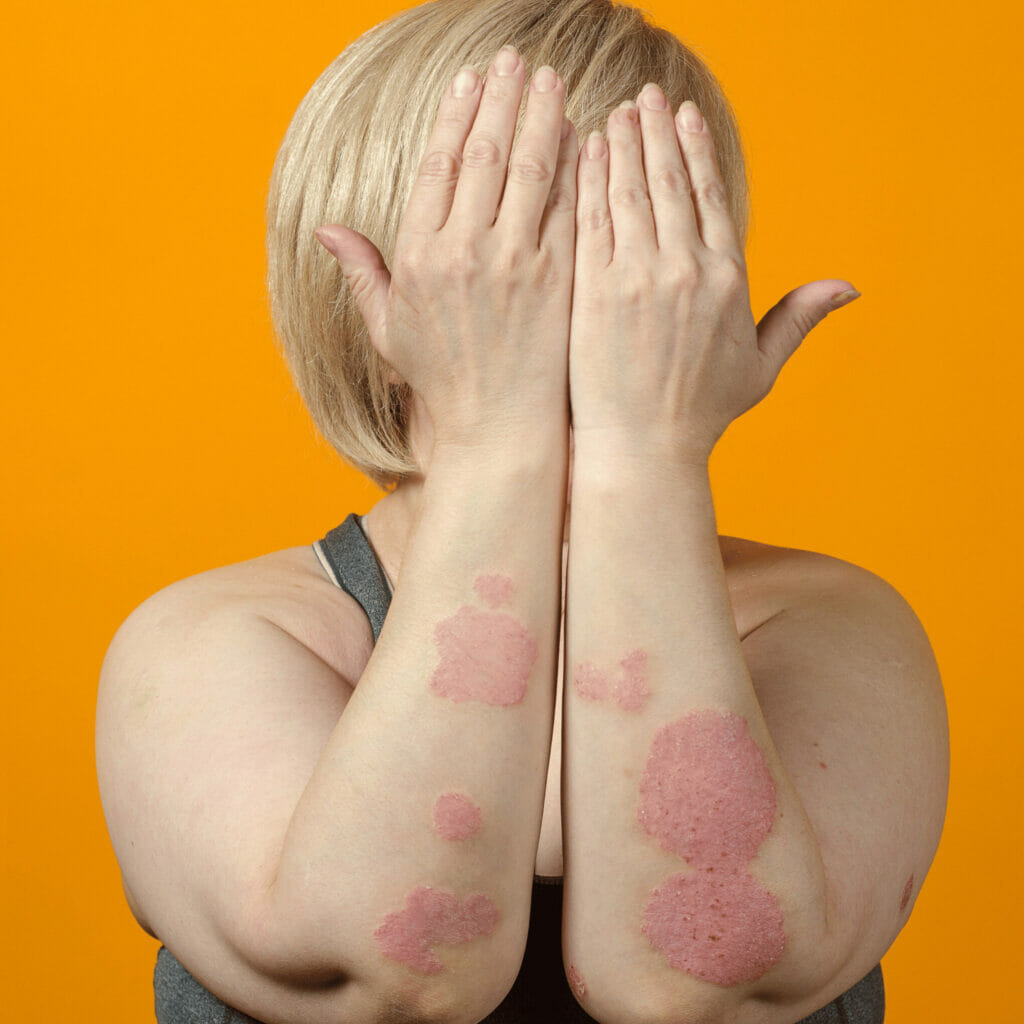 psoriasis in the arms