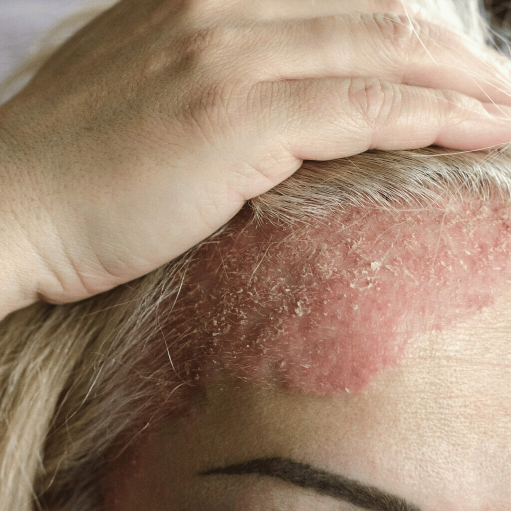 Psoriasis in scalp