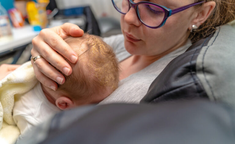 mother looking at her newborn baby head which has dermatologic problem cradle cap seborrheic dermatitis