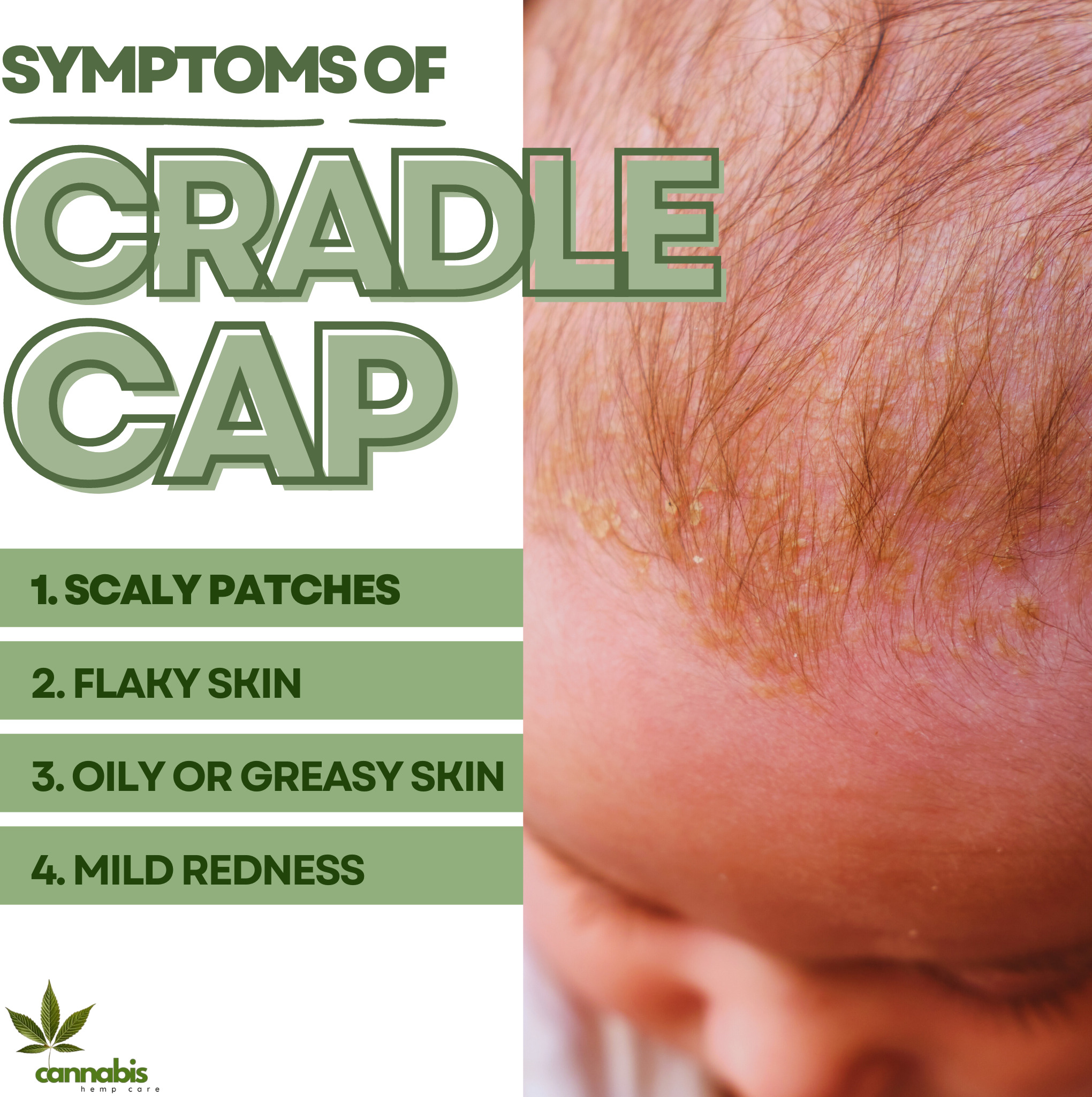 symptoms of cradle cap