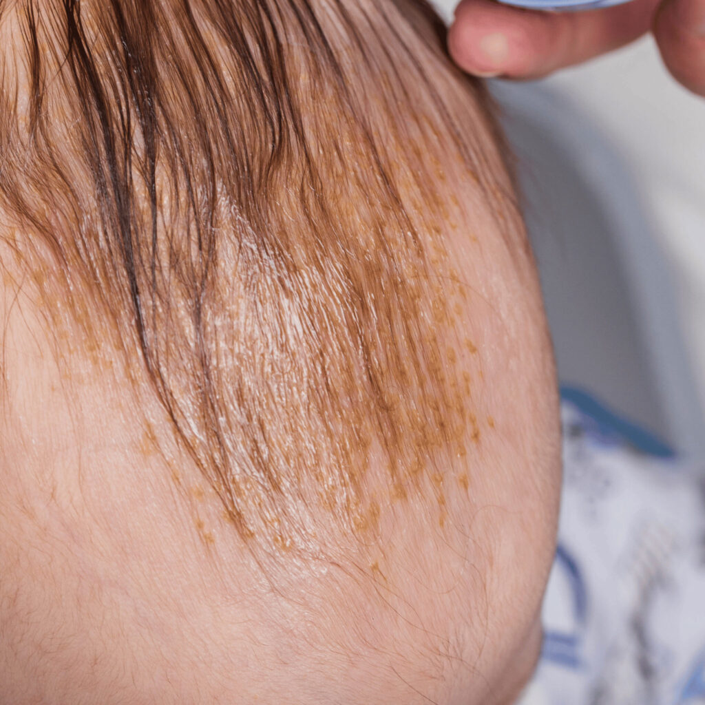 cradle cap daily care routine