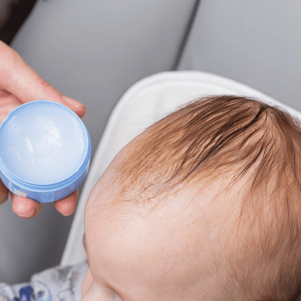 topical treatment of cradle cap